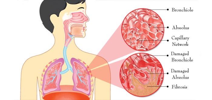 Symptoms of lung fibrosis